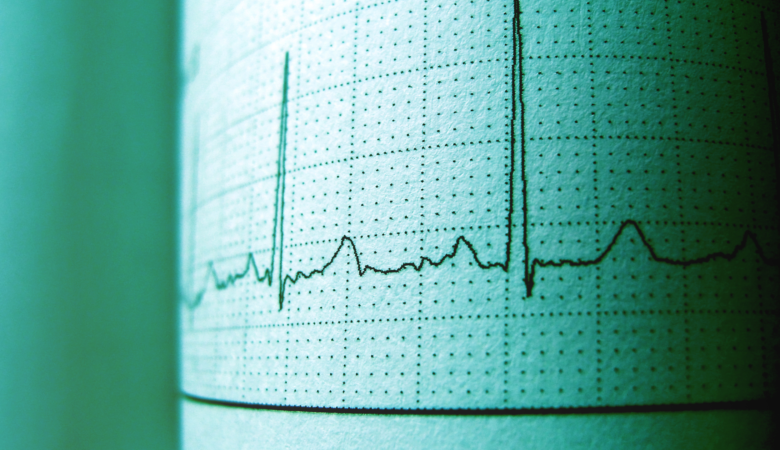 ECG Test in a Female: What You Need to Know About Heart Health